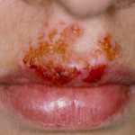 impetigo_342x198_C0175679