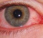 260px-Conjuntivitis_de_inclusión_del_adulto