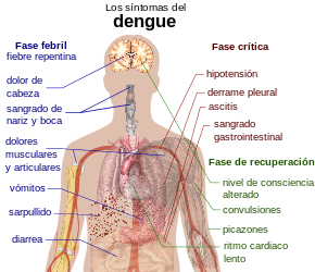 Dengue_fever_symptoms_es.svg