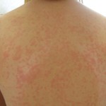 maculopapular-rash-pictures-3