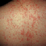 Truncal_rash_in_measles